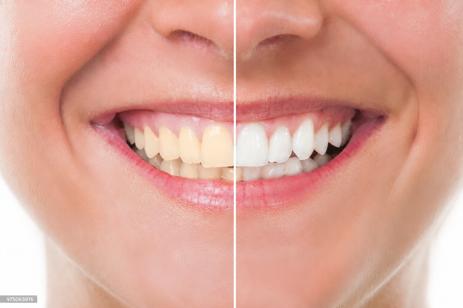 Antes y después de blanqueamiento dental profesional en Pucón